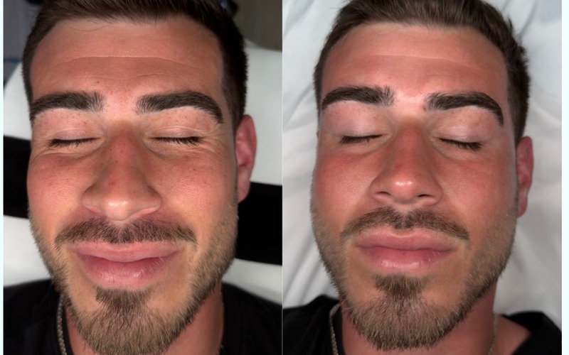 Before HydraFacial