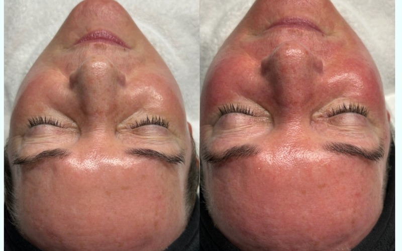 HydraFacial before and after at SlimFit