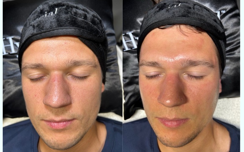 After HydraFacial