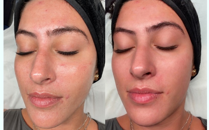 HydraFacial before and after at SlimFit