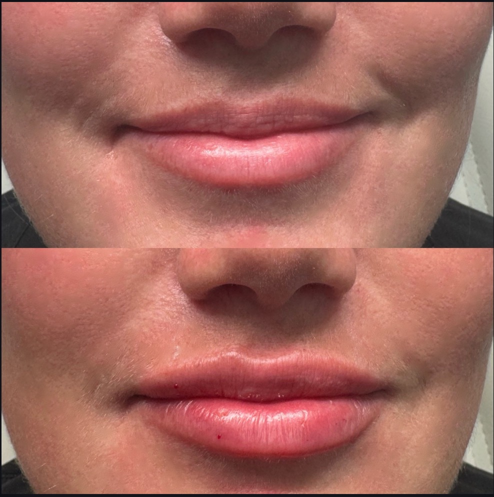 Lip filler before and after at SlimFit