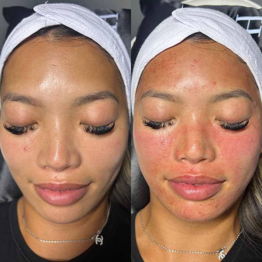 Microneedling before and after