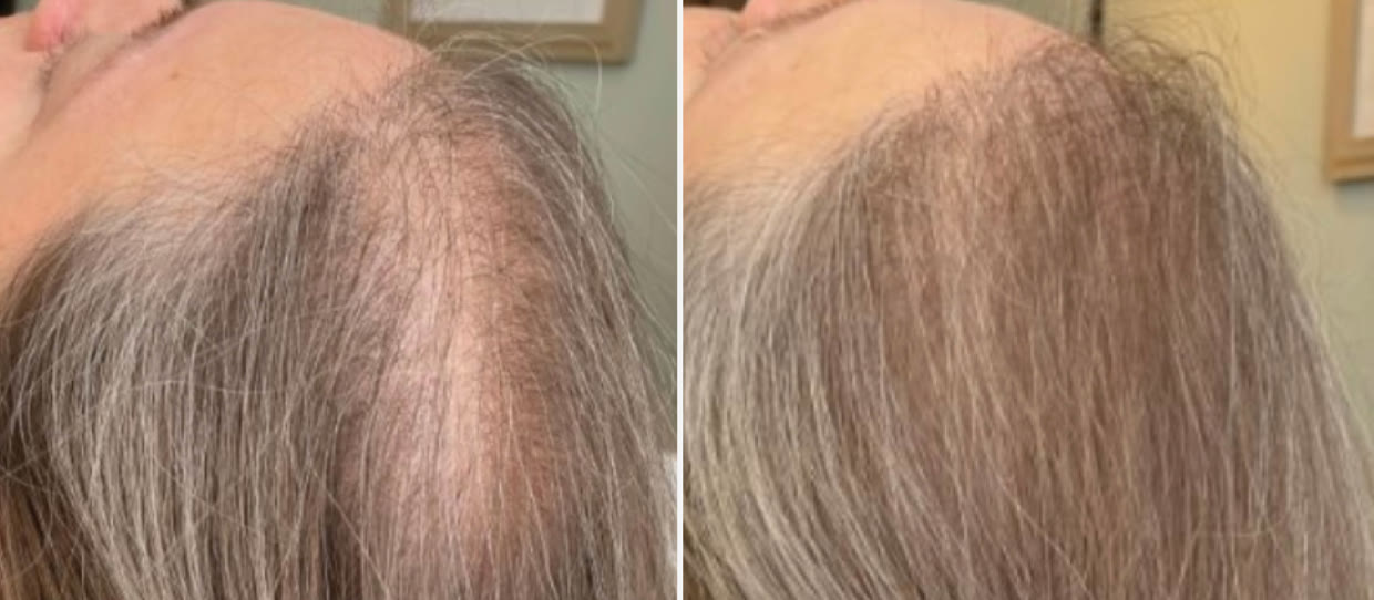 HydraScalp with Keravive before and after, hairline, one month