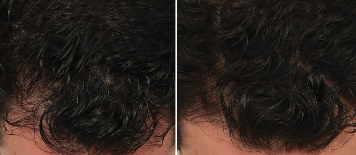HydraScalp with Keravive hairline before and after, three treatments