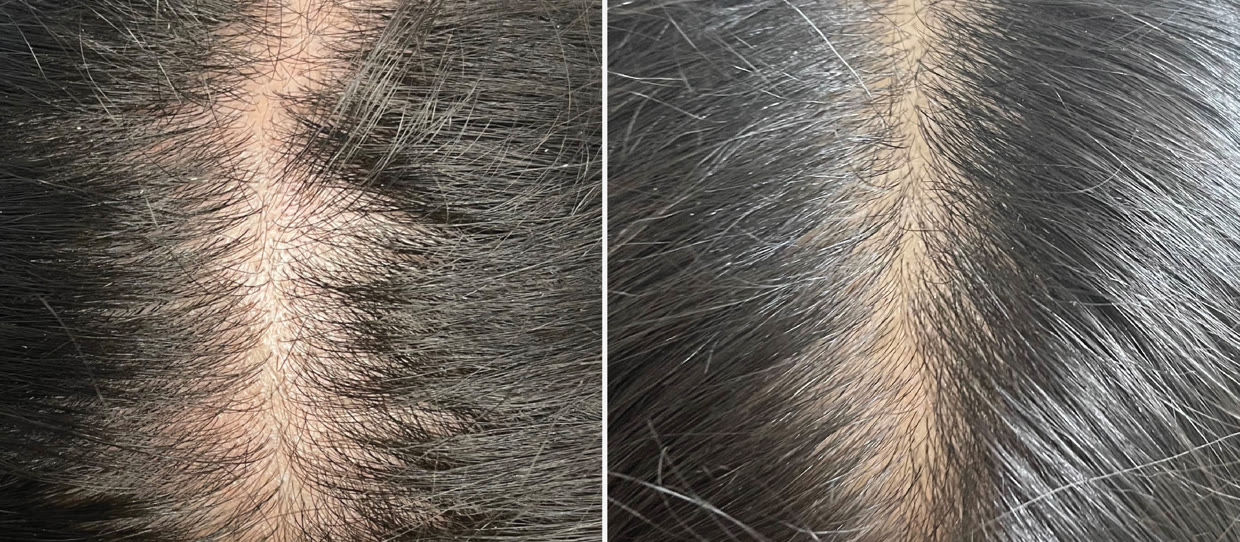 HydraScalp with Keravive scalp before and after, crown, one month